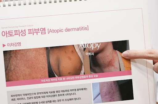 생기한의원으로 살펴보는 아토피 진물 증상과 확인 사항