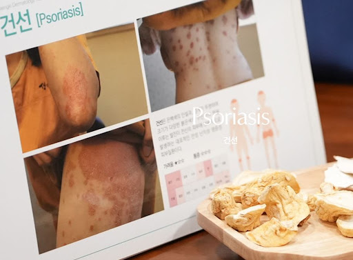 생기한의원이 안내하는 건선과 습진 구분 시 확인할 점